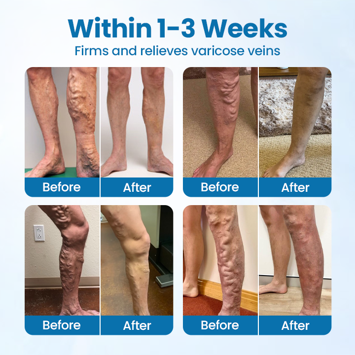 100K+ SOLD 🔥 VeinGuard Herbal Spray-✅ Clinically proven to eliminate varicose veins in just 30 days!