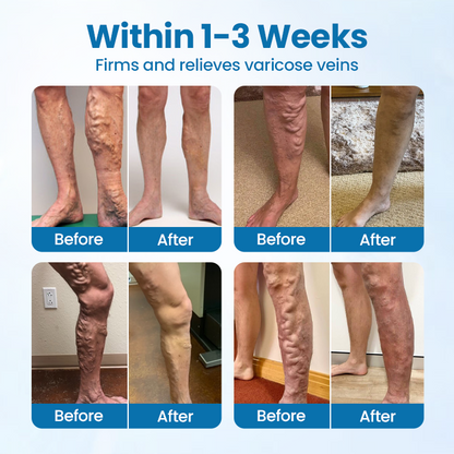 100K+ SOLD 🔥 VeinGuard Herbal Spray-✅ Clinically proven to eliminate varicose veins in just 30 days!