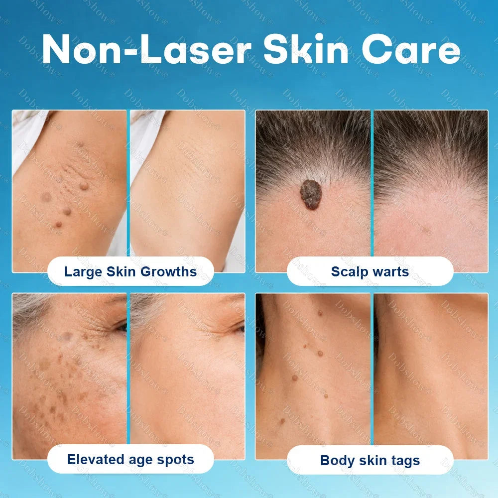 Healrize® 7-Day Blemish Remover, Painless and Scar-Free — Advanced Ballpoint Pen for Skin Tags and Spots