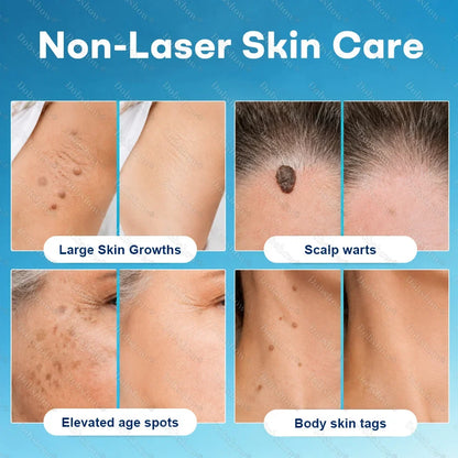 Healrize® 7-Day Blemish Remover, Painless and Scar-Free — Advanced Ballpoint Pen for Skin Tags and Spots