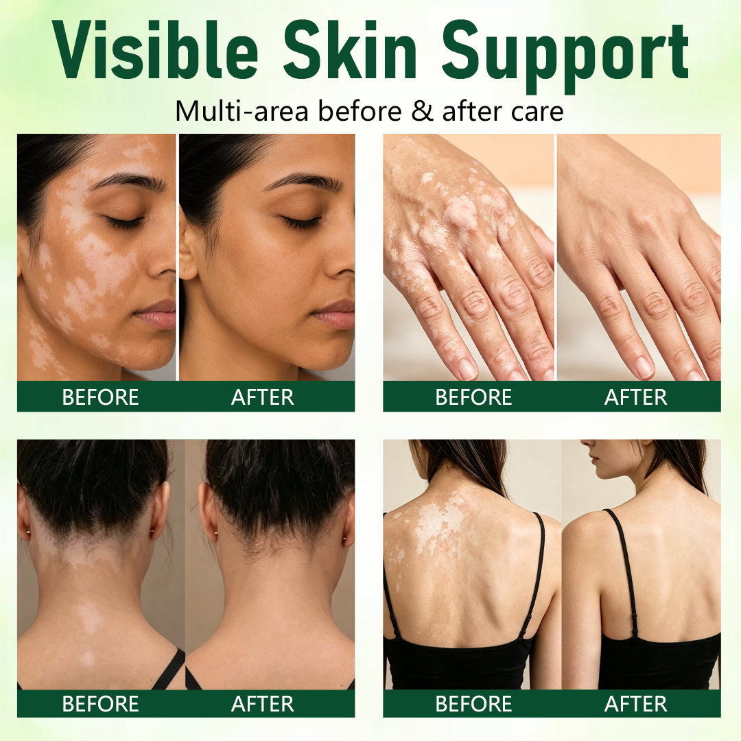 100K+ SOLD 🔥 Dobshow® Herbal Vitiligo Cream 👍