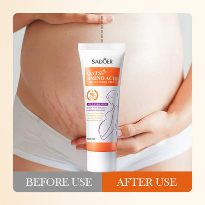 Stretch Mark Cream – Moisturizing Belly Care Cream for Pregnancy & Postpartum Skin