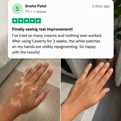 100K+ SOLD 🔥 Dobshow® Herbal Vitiligo Cream 👍